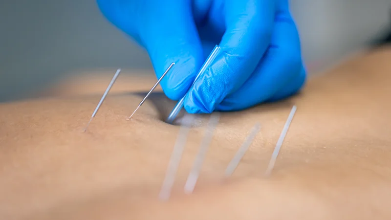 Çfarë është dry needling dhe si kryhet?