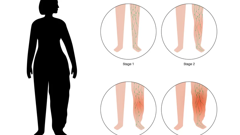 Çfarë është lipedema dhe cilat janë simptomat e saj?